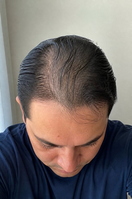 Antes